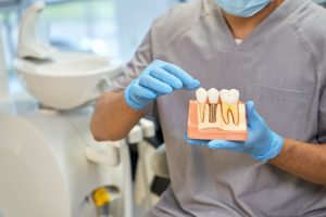 implantes clínica dental torrent