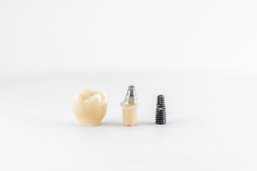 implantes dentales en torrent 4