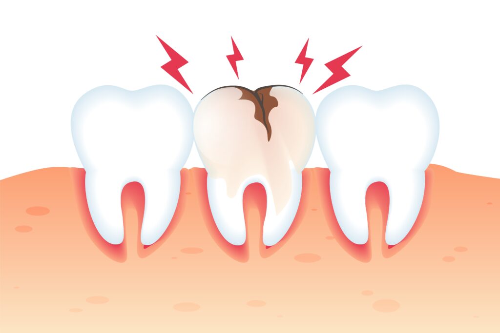 erosion dental