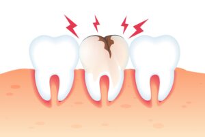 erosion dental