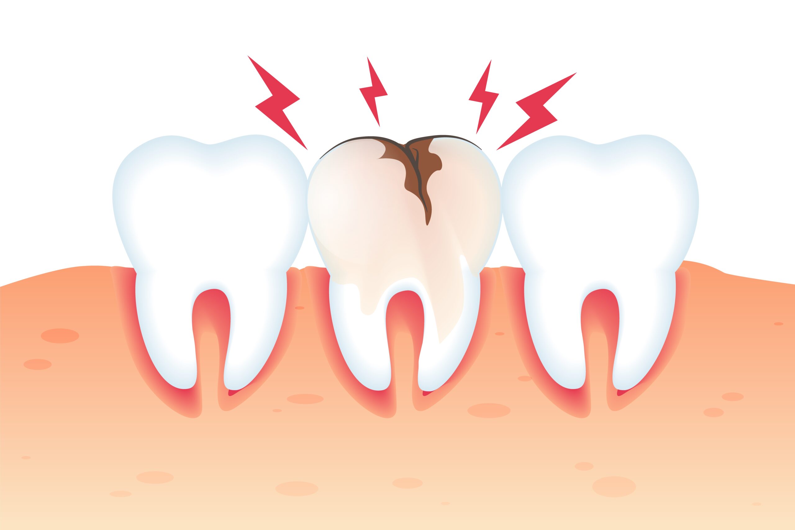 erosion dental