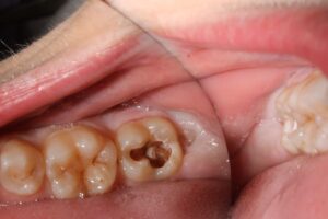 muela caries profunda