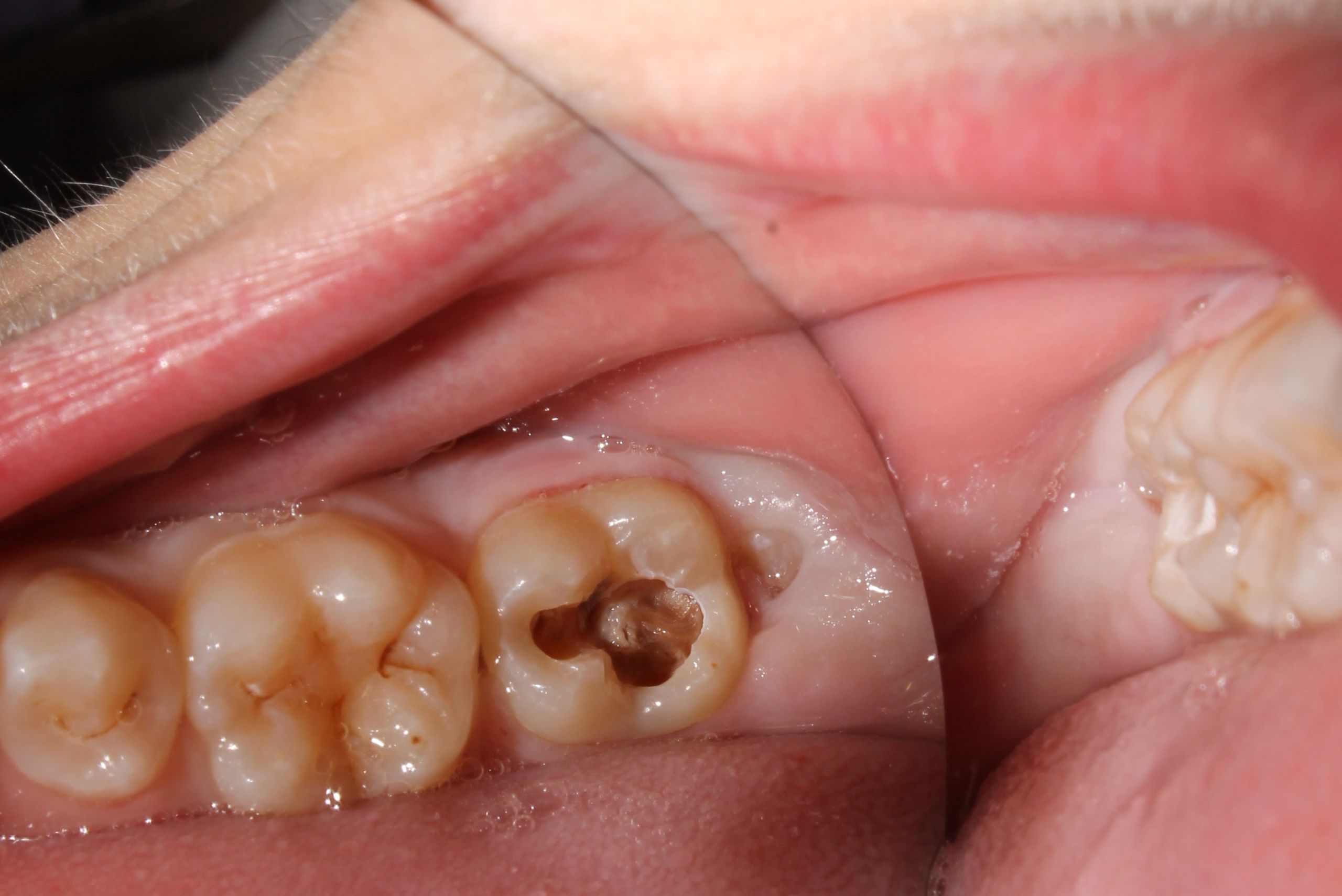 muela caries profunda