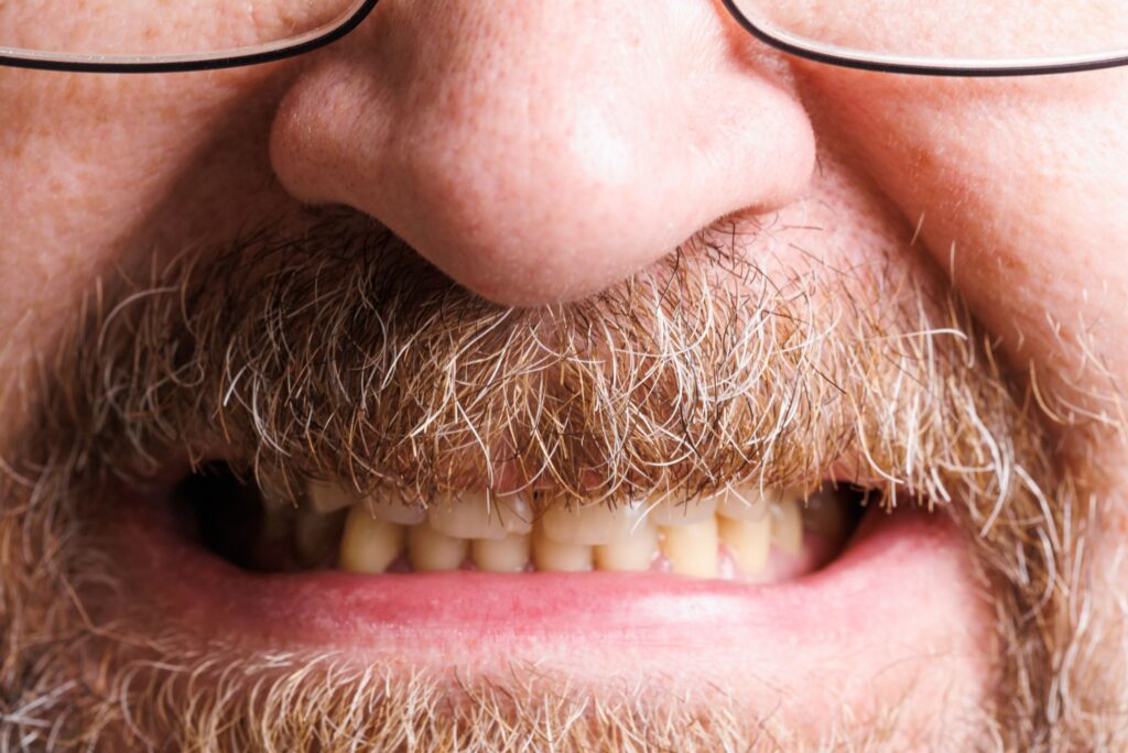 quitar sarro dientes